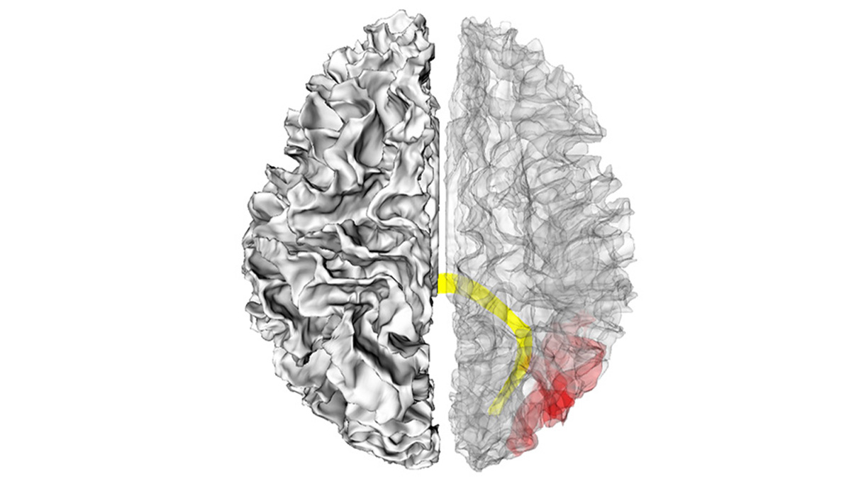 An imaging of a brain identifying the splenium and right middle occipital gyrus
